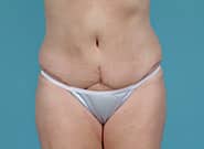 After Image: Abdominoplasty - front