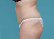 After Image: Abdominoplasty - left-side