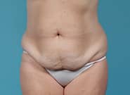 Before Image: Abdominoplasty - front