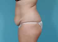 Before Image: Abdominoplasty - left-side