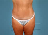 After Image: Abdominoplasty - front