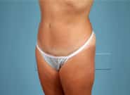 After Image: Abdominoplasty - left-front-oblique