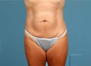 Before Image: Abdominoplasty - front