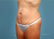 Before Image: Abdominoplasty - left-front-oblique