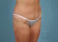 After Image: Abdominoplasty - right-front-oblique
