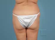 After Image: Abdominoplasty - back