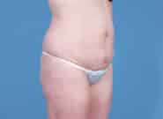 Before Image: Abdominoplasty - right-front-oblique