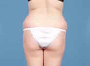 Before Image: Abdominoplasty - back