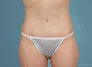 After Image: Abdominoplasty - front