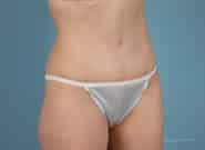 After Image: Abdominoplasty - right-front-oblique