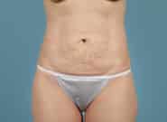 Before Image: Abdominoplasty - front