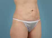 Before Image: Abdominoplasty - right-front-oblique
