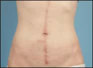 After Image: Abdominoplasty Vertical Scar - front