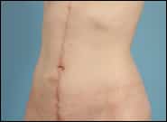 After Image: Abdominoplasty Vertical Scar - left-front-oblique