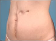 Before Image: Abdominoplasty Vertical Scar - left-front-oblique