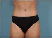 After Image: Abdominoplasty with epigastric hernia repair - front