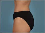 After Image: Abdominoplasty with epigastric hernia repair - left-side