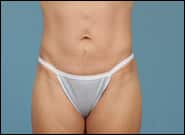 Before Image: Abdominoplasty with epigastric hernia repair - front