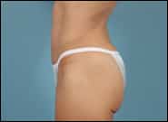 Before Image: Abdominoplasty with epigastric hernia repair - left-side