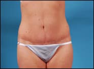 After Image: Abdominoplasty - front