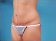 After Image: Abdominoplasty - left-front-oblique