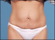 Before Image: Abdominoplasty - front