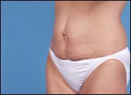 Before Image: Abdominoplasty - left-front-oblique