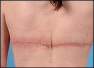After Image: Back Lift - back