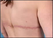 After Image: Back Lift - right-back-oblique