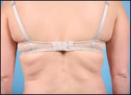 Before Image: Back Lift - back