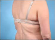 Before Image: Back Lift - right-back-oblique
