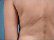 After Image: Breast Reconstruction Latissimus - back