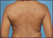 After Image: Breast Reconstruction Latissimus - back
