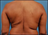 After Image: Breast Reconstruction Latissimus - back