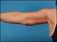 After Image: Brachioplasty - front