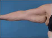 Before Image: Brachioplasty - front