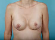 After Image: Breast Augmentation - front