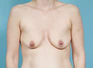 Before Image: Breast Augmentation - front