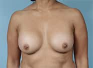 After Image: Breast Augmentation - front