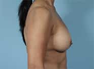 After Image: Breast Augmentation - right-side