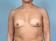 Before Image: Breast Augmentation - front