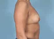 Before Image: Breast Augmentation - right-side
