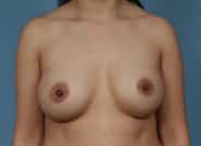 After Image: Breast Augmentation - front