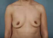 Before Image: Breast Augmentation - front