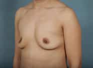 Before Image: Breast Augmentation - left-front-oblique