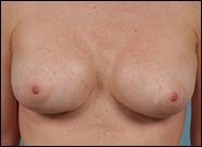 After Image: Breast Augmentation with Mastopexy - front