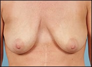 Before Image: Breast Augmentation with Mastopexy - front