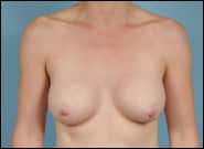 After Image: Breast Augmentation - front