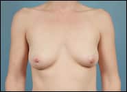 Before Image: Breast Augmentation - front