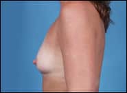 Before Image: Breast Augmentation - left-side